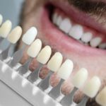 Composite Veneers image