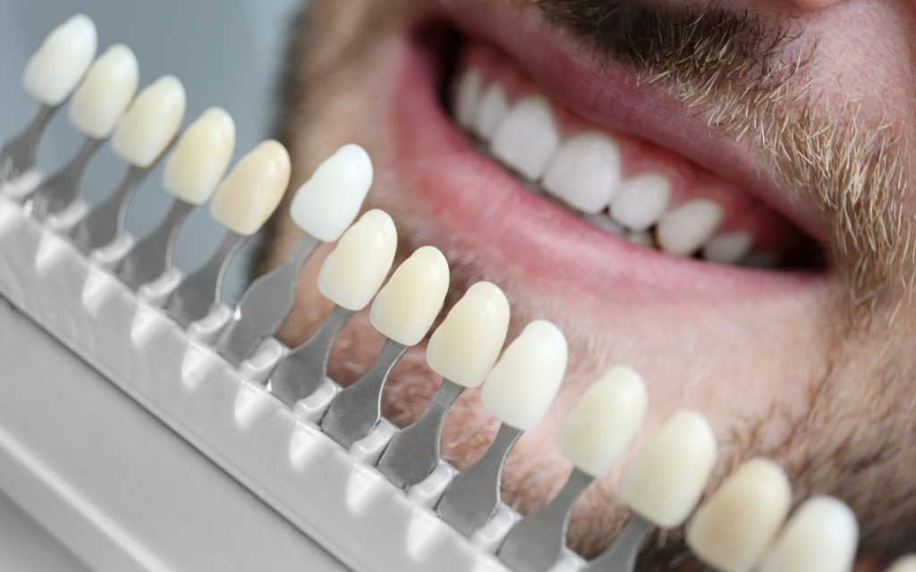 Composite Veneers image